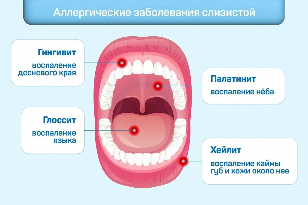 Боль и воспаление нёба