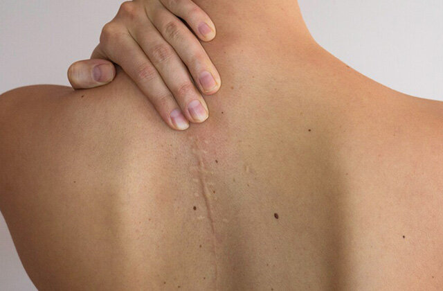 Способы удаления шрамов и рубцов