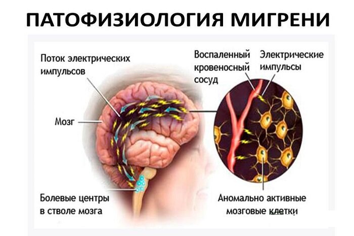 Психическое напряжение переходит в нервное, где мозговые клетки становятся аномально активными.