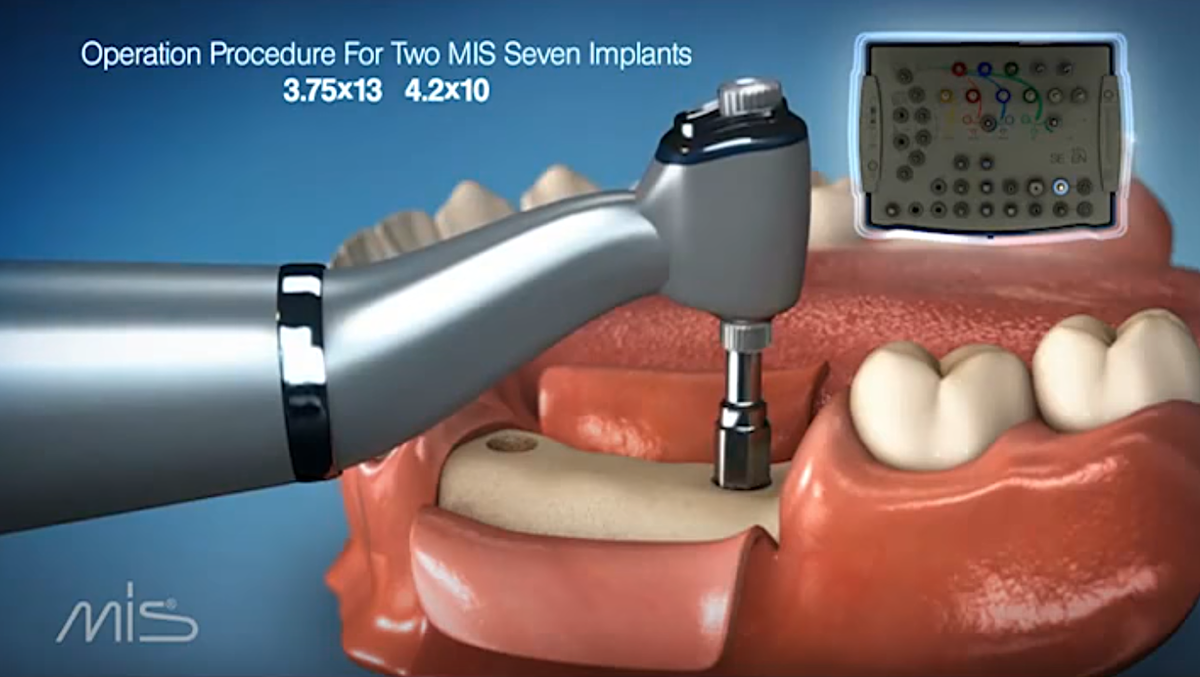 Как устанавливают имплантаты? (Видео) | MIS-INFO.RU | Дзен