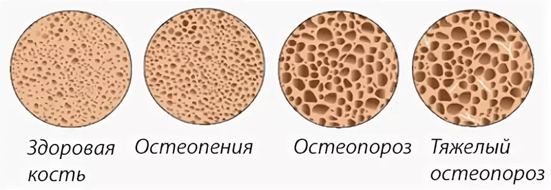 Снижение плотности костей