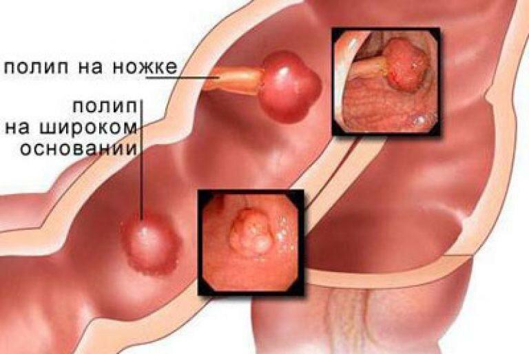 Гастроинтестинальные стромальные опухоли (ГИСО) лечение в Москве | 🏥 Клиника НАКФФ