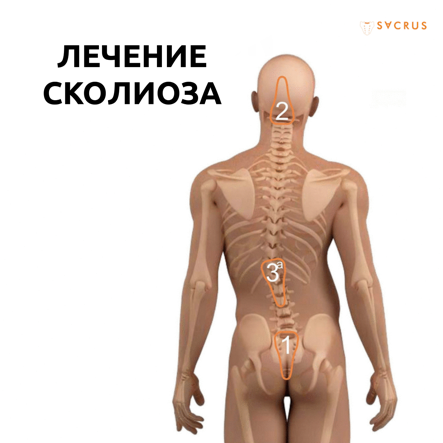 Виды миозита мышц спины