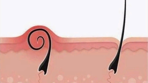 Образование вросших волос