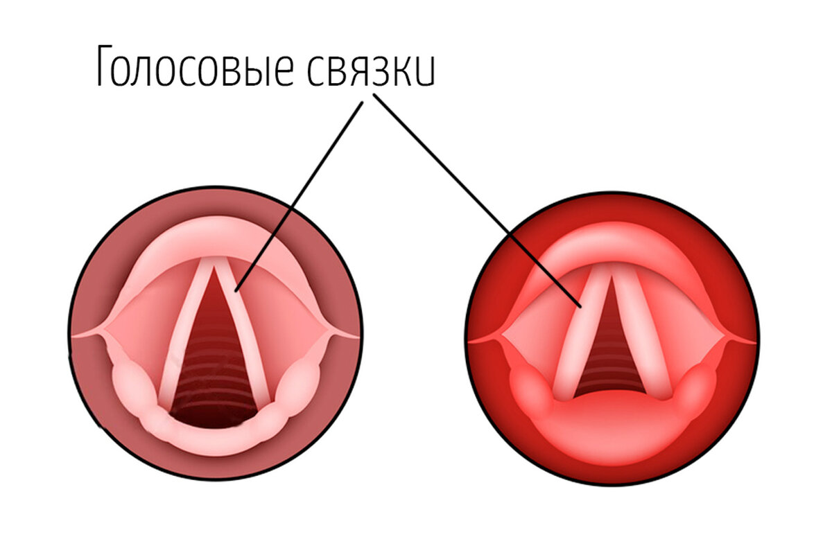 Фарингит - что это такое?