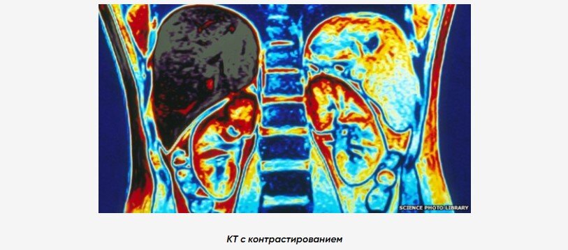 Компьютерная томография (КТ) – медицинский метод исследования с использованием рентгеновских лучей, позволяющий получить важную диагностическую информацию.