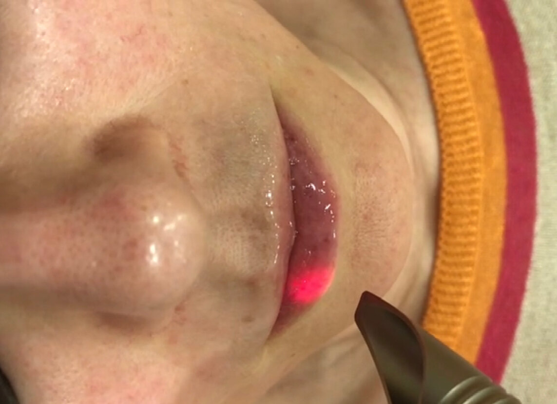 процедура лазерной доставки гиалуроновой кислоты в ткани губы и параллельное разглаживание «сморщенности» последних. 