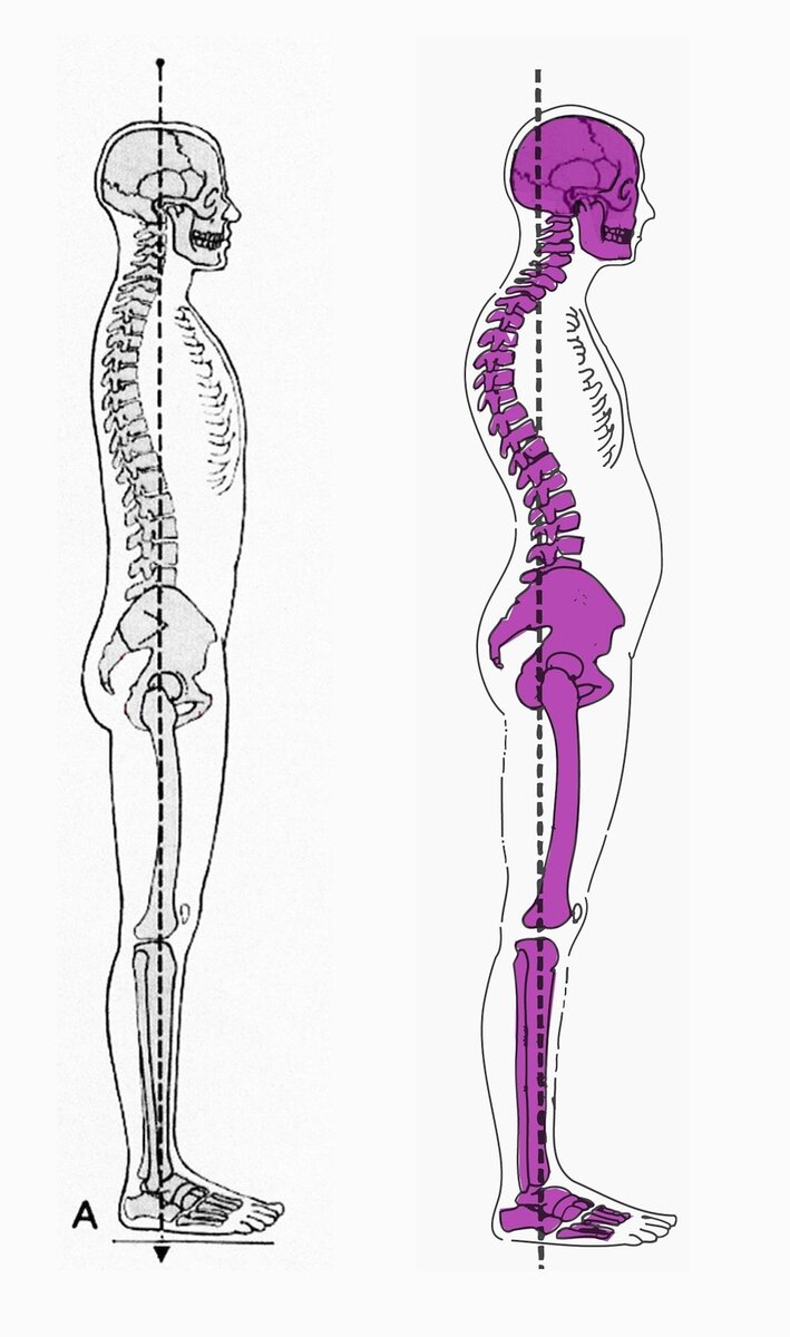 Выпячивание живота при нарушениях в поясничном отделе. Источник изображения: Яндекс.Картинки