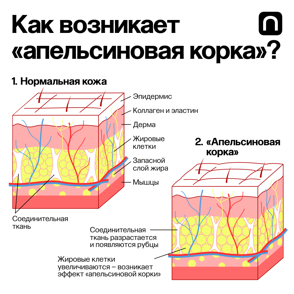 «Апельсиновая корка» — то, что обычно люди называют «целлюлитом»