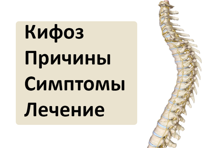 Виды кифоза позвоночника