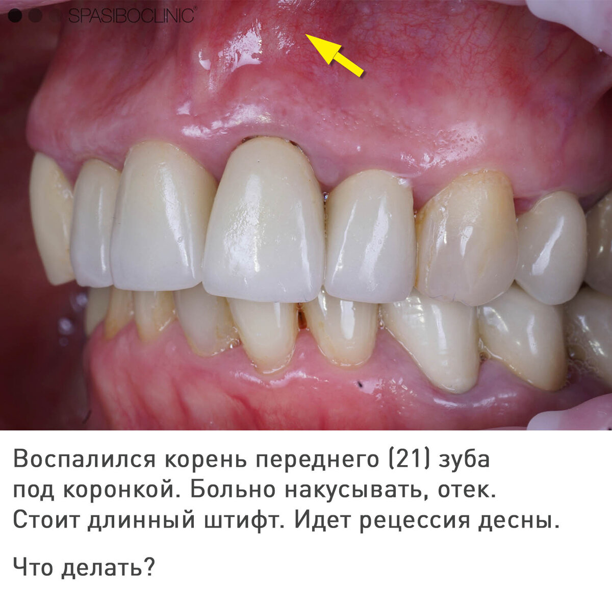 Воспаление корня зуба: симптомы, лечение, профилактика