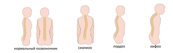 Виды позвоночника. Осанка лордоз кифоз сколиоз. Нарушения осанки лордозы кифозы. Деформации позвоночника кифоз лордоз сколиоз. Лордоз кифоз сколиоз у детей.