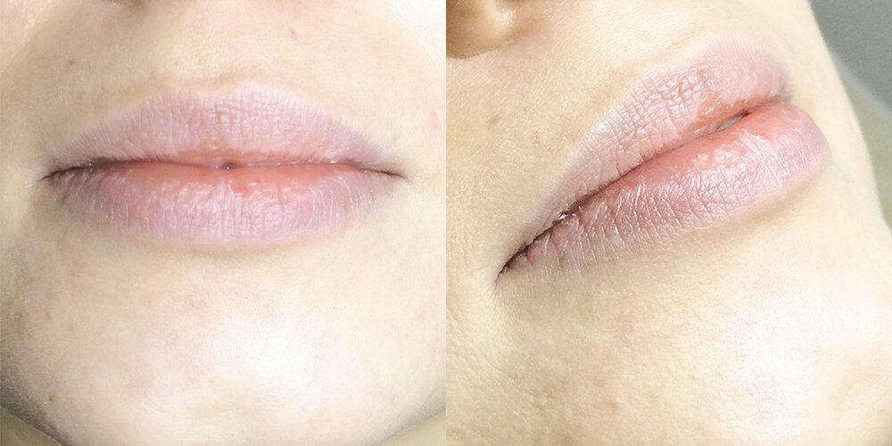 Сухие губы: профилактика и лечение