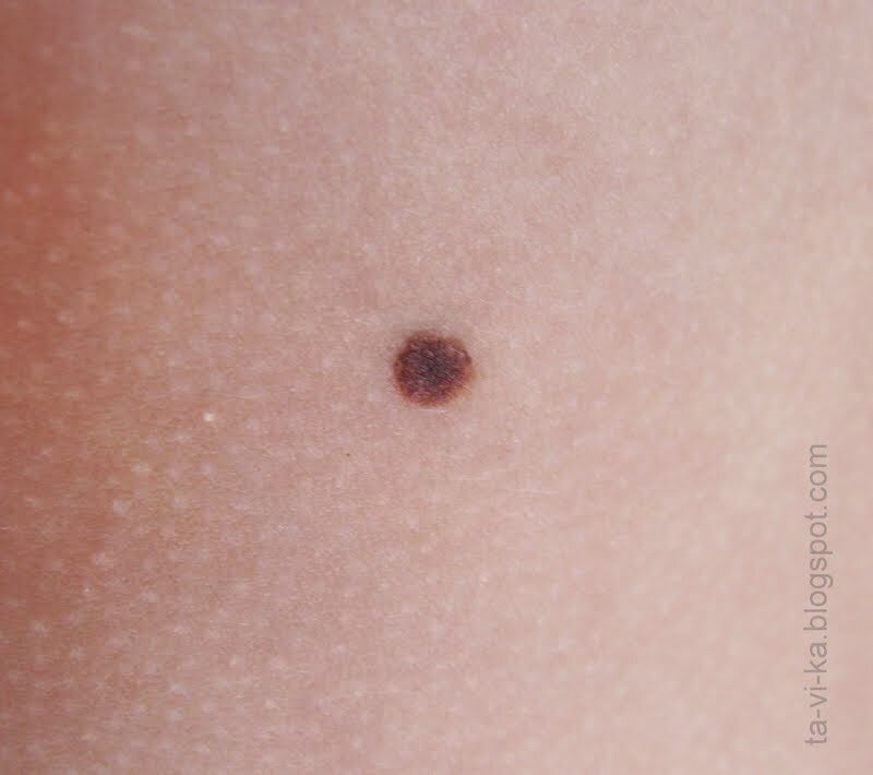 Это обыкновенная родинка. Источник Tavika