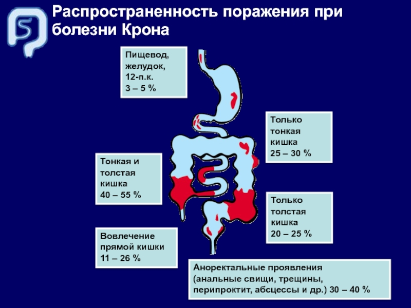 Болезнь крона какой стол