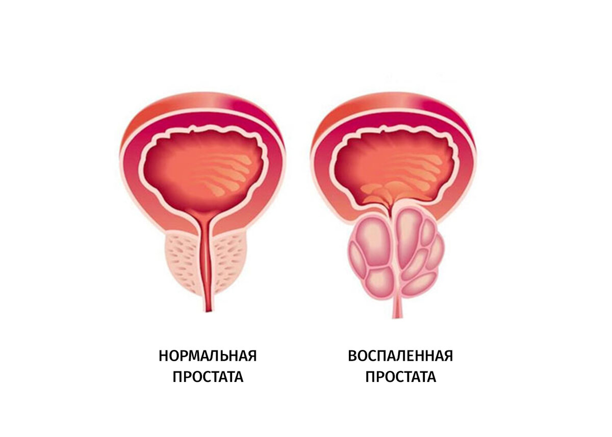 Воспаление предстательной железы