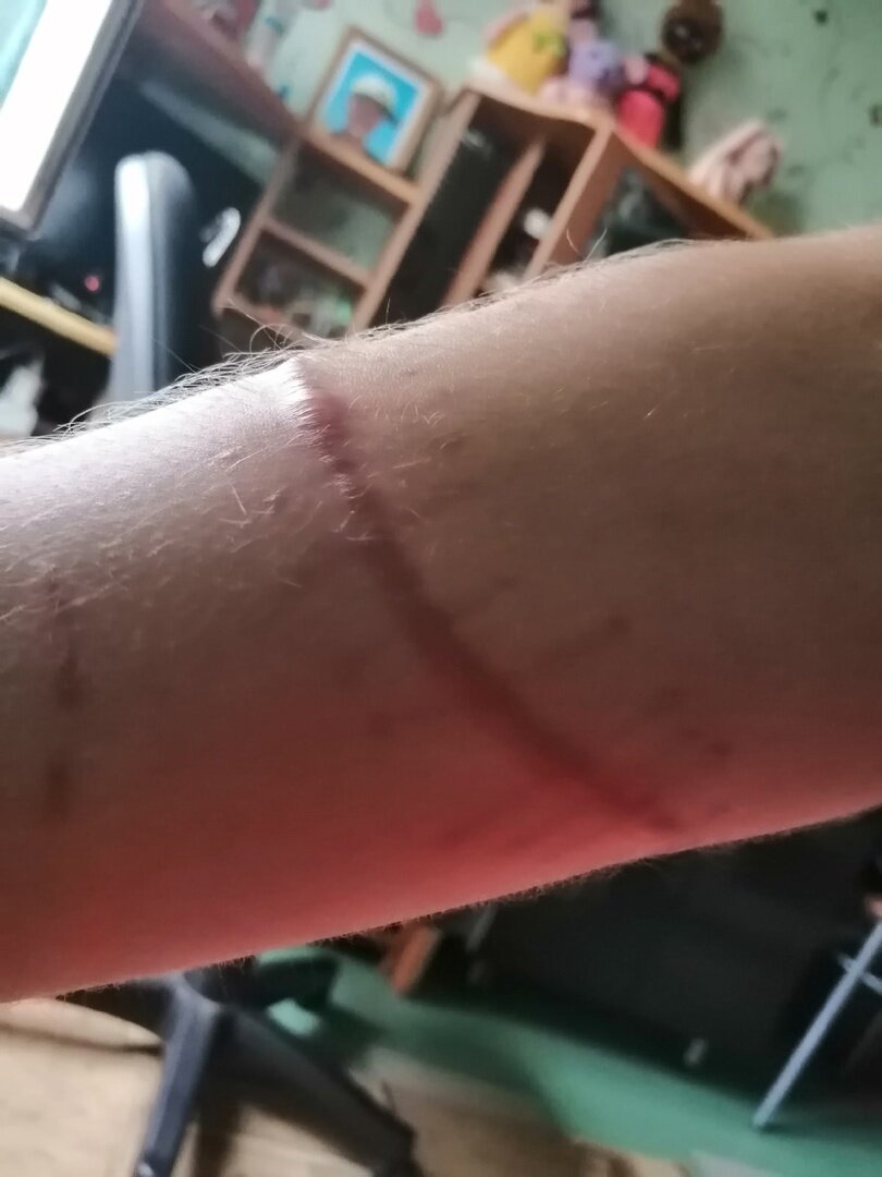 рука с шрамом