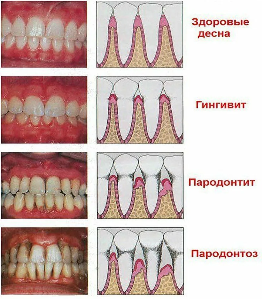 Воспаление десен: причины, лечение и профилактика