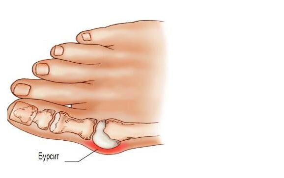 Бурсит на пальце руки фото