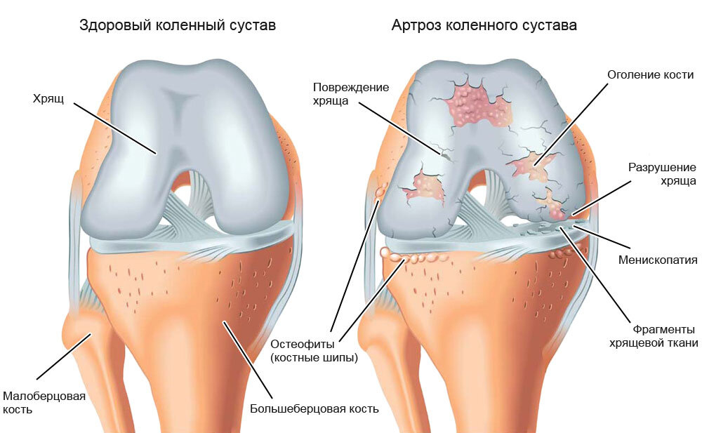 Гонартроз 1 степени коленного сустава лечение