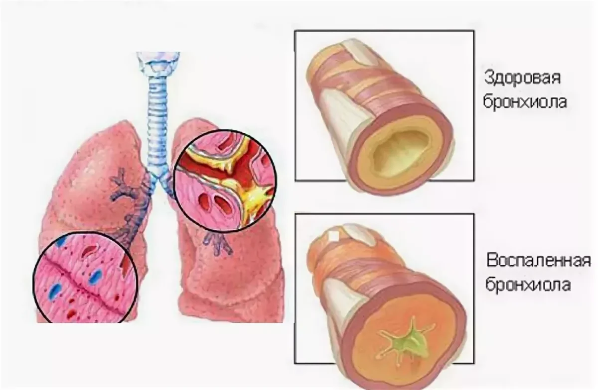 Бронхит что это такое. Обструктивный бронхит бронхи. Поражение бронхов острый бронхит. Воспаление слизистой оболочки бронхов. Хронический обструктивный бронхит рисунок.