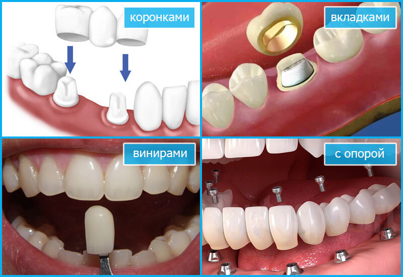 Что такое коронка зуба и мосты