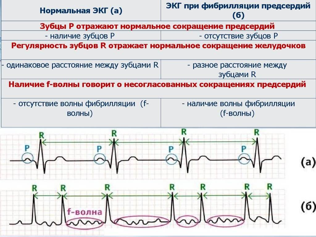 Фибрилляция предсердий экг картинки