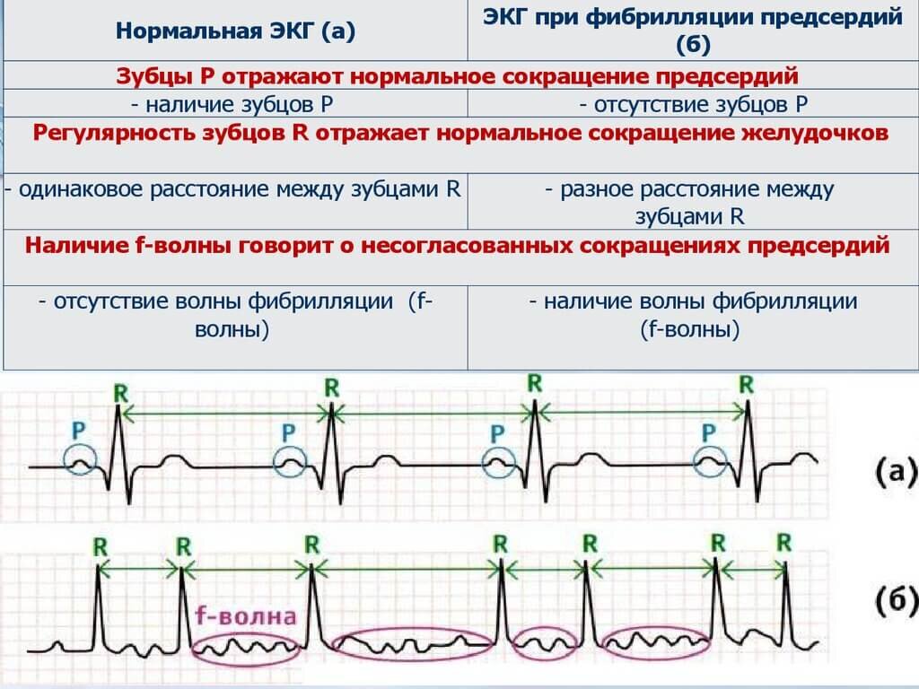 Как выглядит фибрилляция предсердий на экг фото