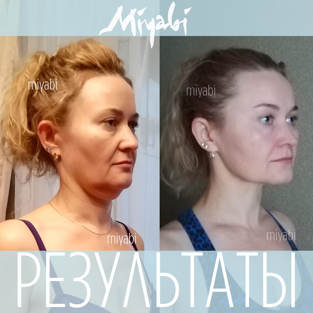 Посмотрите, насколько сильно добавляет визуально возраста хронический отёк на лице. Мешки под глазами, носогубные складки, второй подбородок часто исчезают совсем - стоит лишь восстановить здоровый лимфоток и снять хронические отёки.