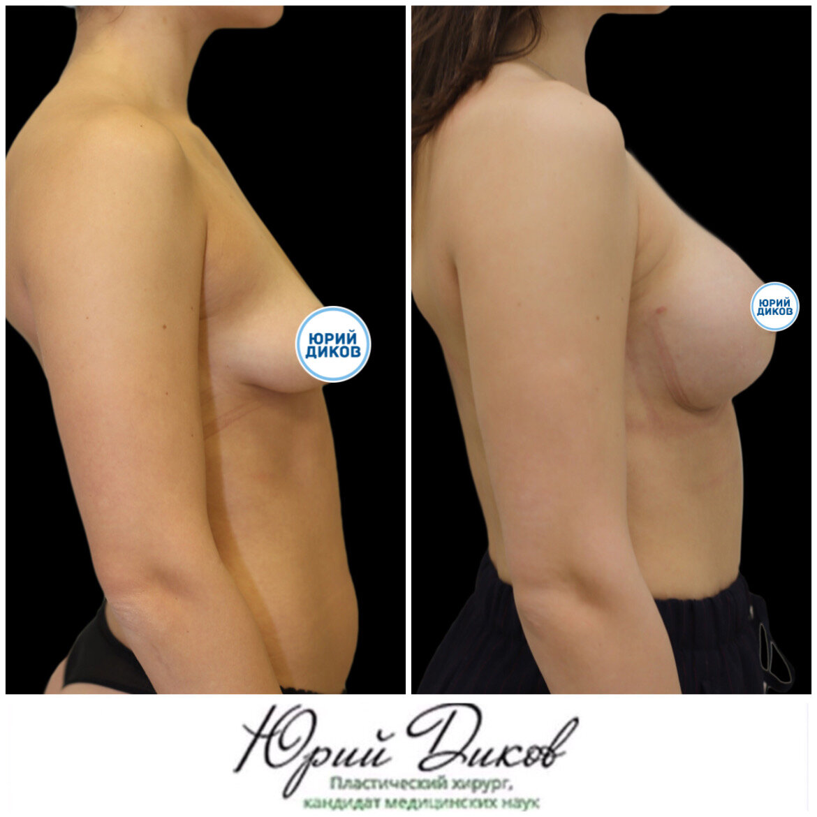 тубулярная деформация груди у женщин фото 27