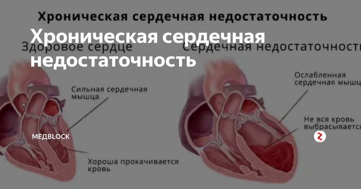 Поражение сердца без застойной сердечной недостаточности. ХСН хроническая сердечная недостаточность симптомы. Острая и хроническая сердечная недостаточность симптомы. Хроническая систолическая сердечная недостаточность. Острая хроническая недостаточность сердца.