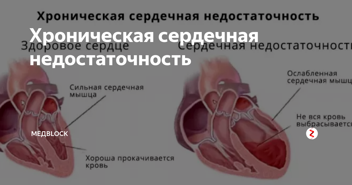 Симптомы сердечной недостаточности. ХСН хроническая сердечная недостаточность симптомы. Острая и хроническая сердечная недостаточность симптомы. Хроническая систолическая сердечная недостаточность. Острая хроническая недостаточность сердца.