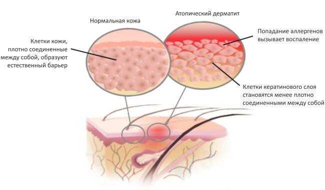   Дерматит – аллергическое заболевание, протекающее с периодами ремиссии. В период обострения на некоторых частях или на всей коже образуются покраснения.-2