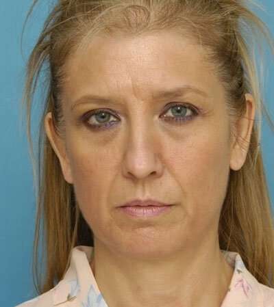 До комплекса процедур фотоомоложения