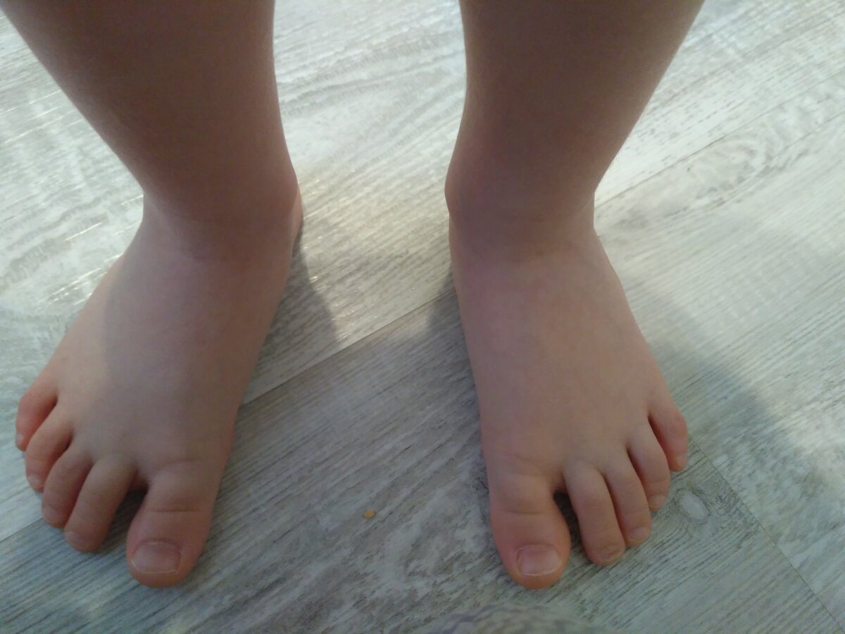 Вальгусная деформация стопы у детей фото