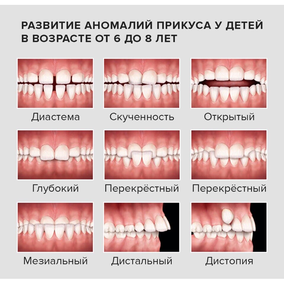 Какой правильный прикус у человека картинки должен быть