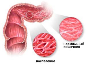 спаление кишечника» - выражение, употребляемое при возникновении таких симптомов нарушения пищеварения, как дискомфорт, тяжесть, болезненные ощущения в области живота, сопровождающееся нарушением стула, которые требуют своевременной диагностики и лечения. Под этим кратким названием скрывается ряд заболеваний, которые обусловлены возникновением воспалительных изменений в слизистой оболочке кишечника, что ведет к нарушению его функционирования.