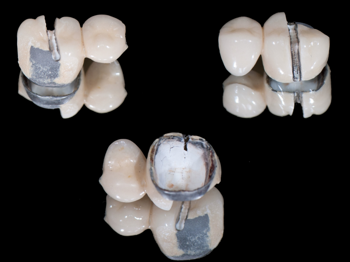 На фото видно, что коронка разрезана полностью, а цемент под ней практически не поврежден  (Работа и фото автора)