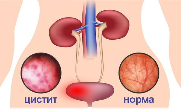 Можжевельник от цистита и простатита