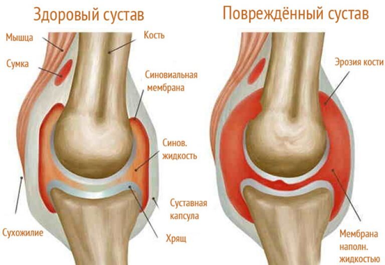 Сустав пораженный подагрой