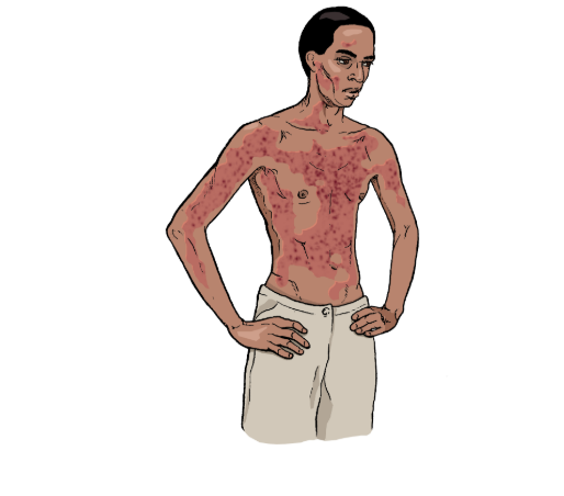 сыпь при лихорадке Эбола