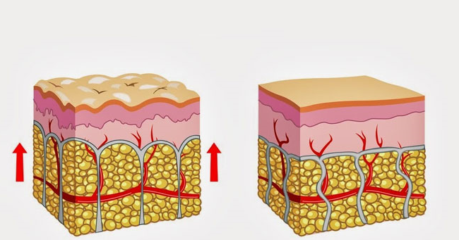 Проявление целлюлита и нормальное состояние.