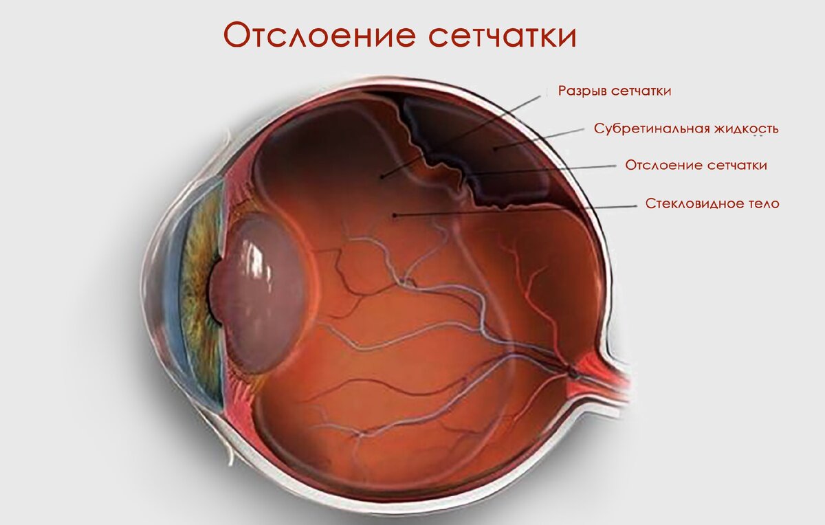 Отслойка сетчатки глаза. Отслойка сетчатки глаза причины и симптомы лечение. Отслоение сетчатки симптомы. Отслоение сетчатки на глазу на глазах. Отслойка сетчатки глаза причины и симптомы лечение.