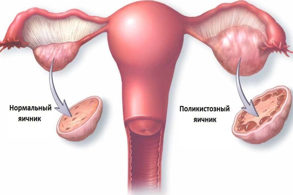 Если яичники перестали работать слишком рано