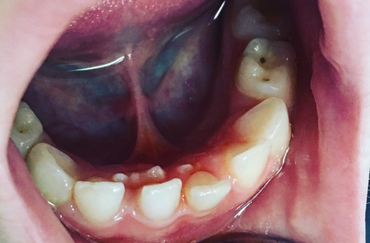 Сверхкомплектные зубы: виды, причины, лечение - центр стоматологии «Тихонова» в Туле