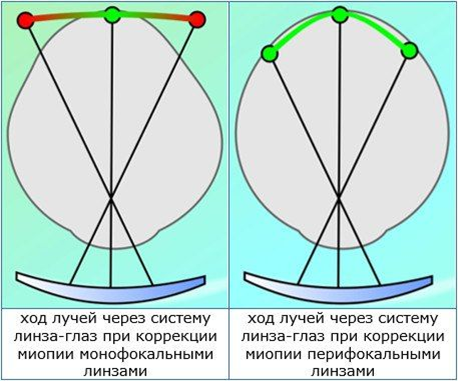Сравнение работы монофокальных и перифокальных линз