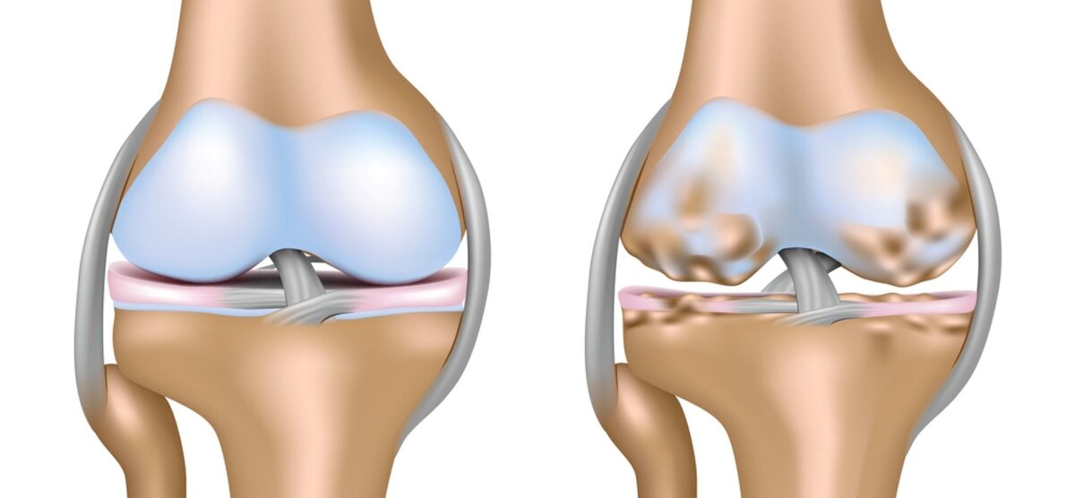 Эти болезни – не просто проблемы с суставами, речь идёт о более серьёзных нарушениях. По своей сути – это дегенеративно-дистрофические изменения в определённой области.