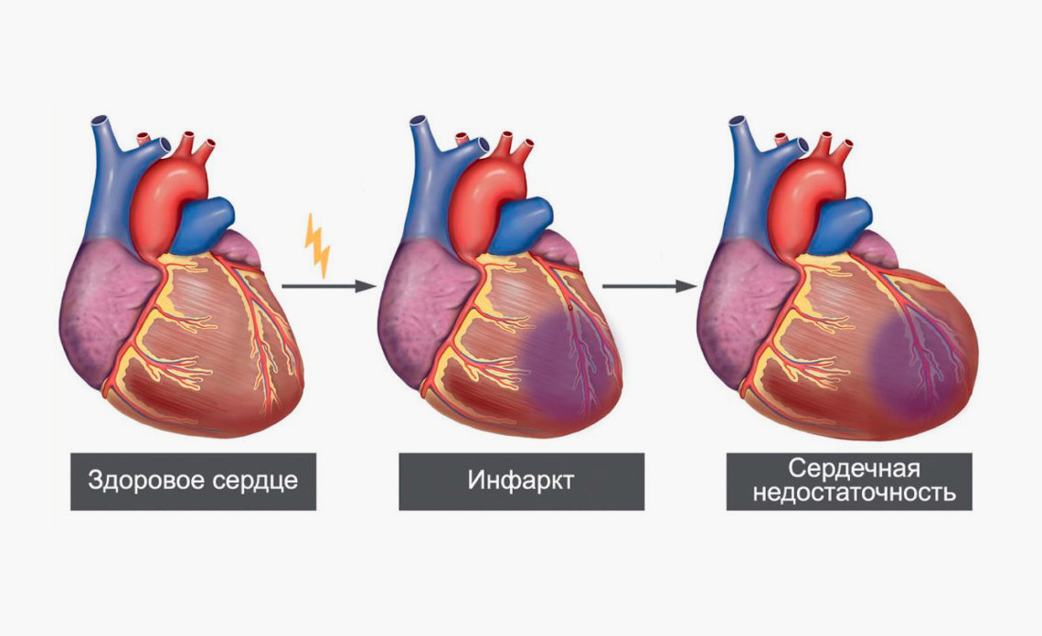 Сердце при инфаркте миокарда. Сердечный ковид