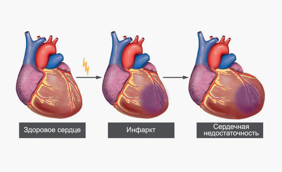 Инфаркт миокарда: почему он возникает, как проявляется и чем его лечат в  клинике | О здоровье: с медицинского на русский | Дзен