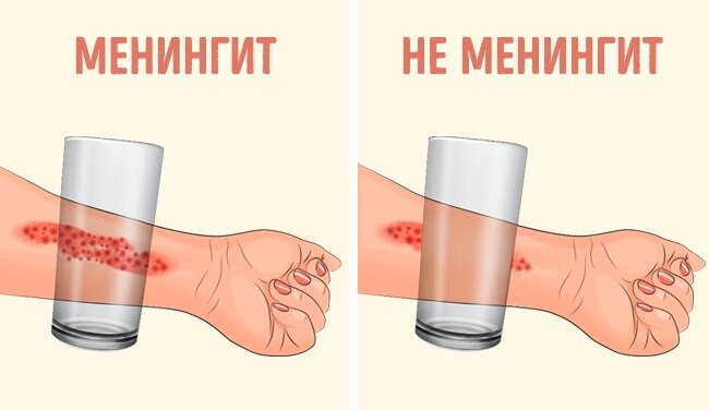 Бактериальный менингит - симптомы, признаки, лечение